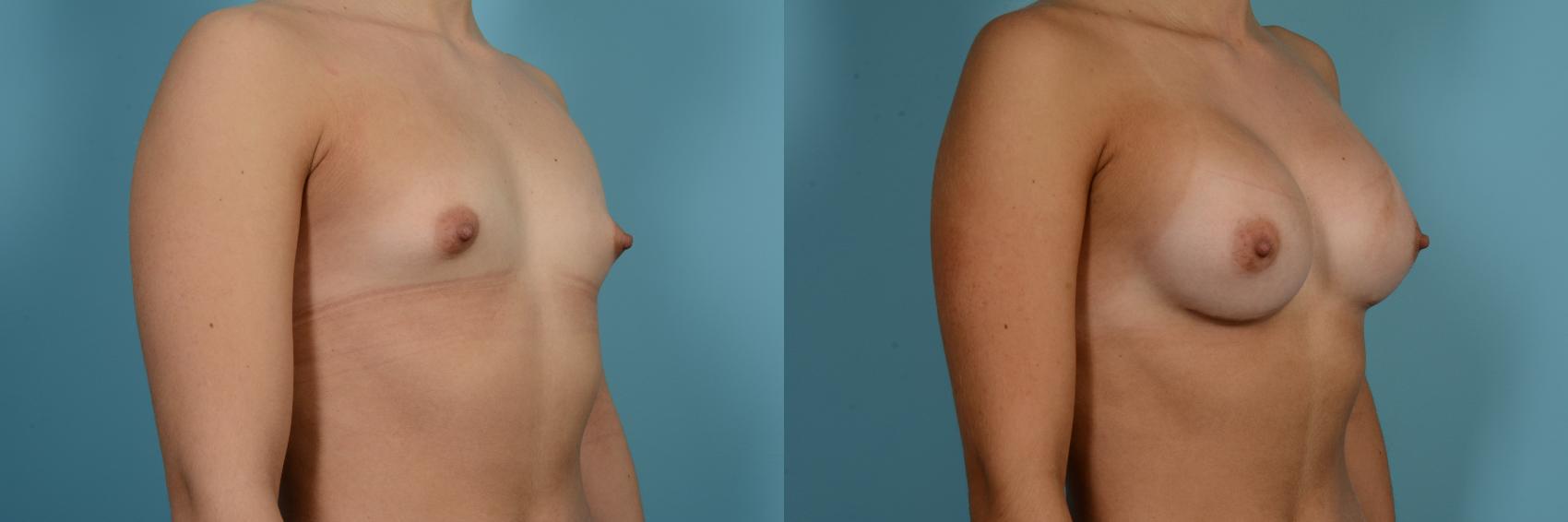 Dr. Sinno Breast Augmentation in Chicago, Illinois