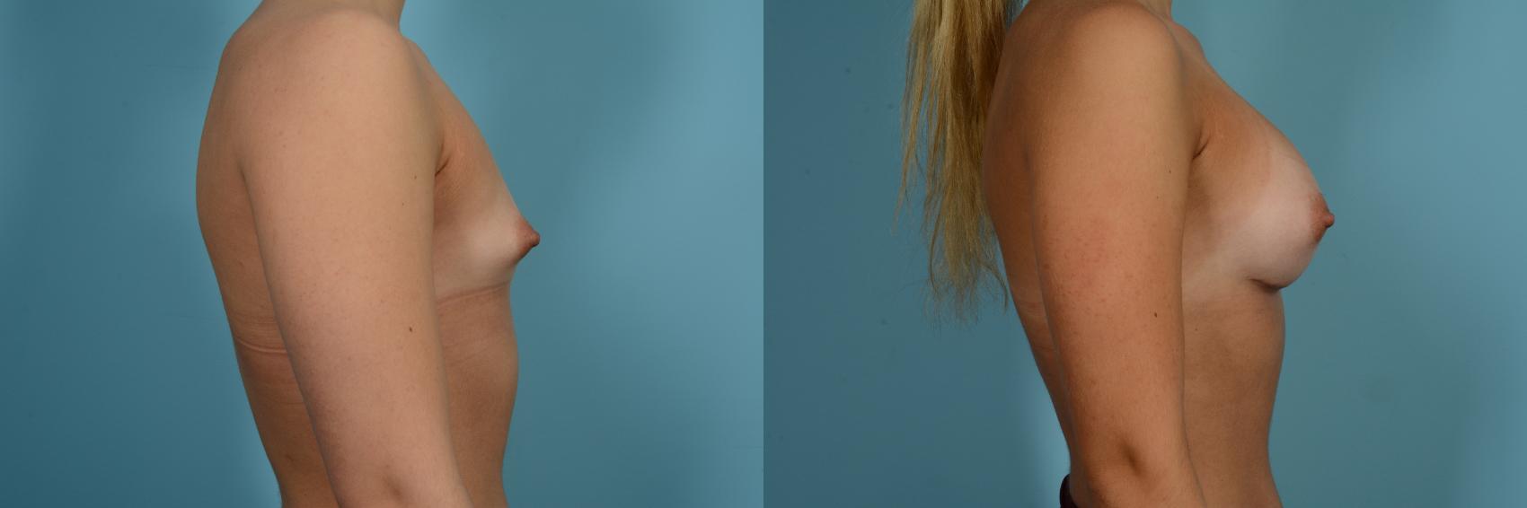 Dr. Sinno Breast Augmentation in Chicago, Illinois
