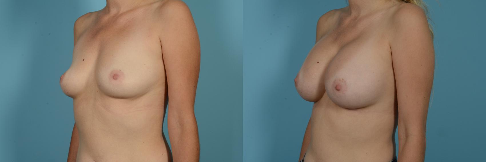 Dr. Sinno Breast Augmentation in Chicago, Illinois