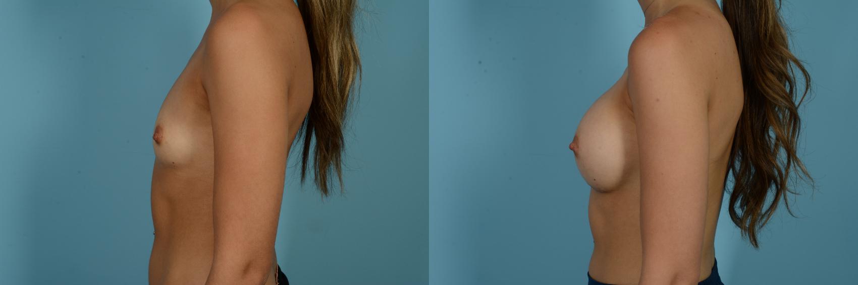 Dr. Sinno Breast Augmentation in Chicago, Illinois