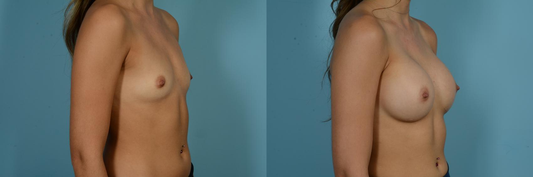 Dr. Sinno Breast Augmentation in Chicago, Illinois