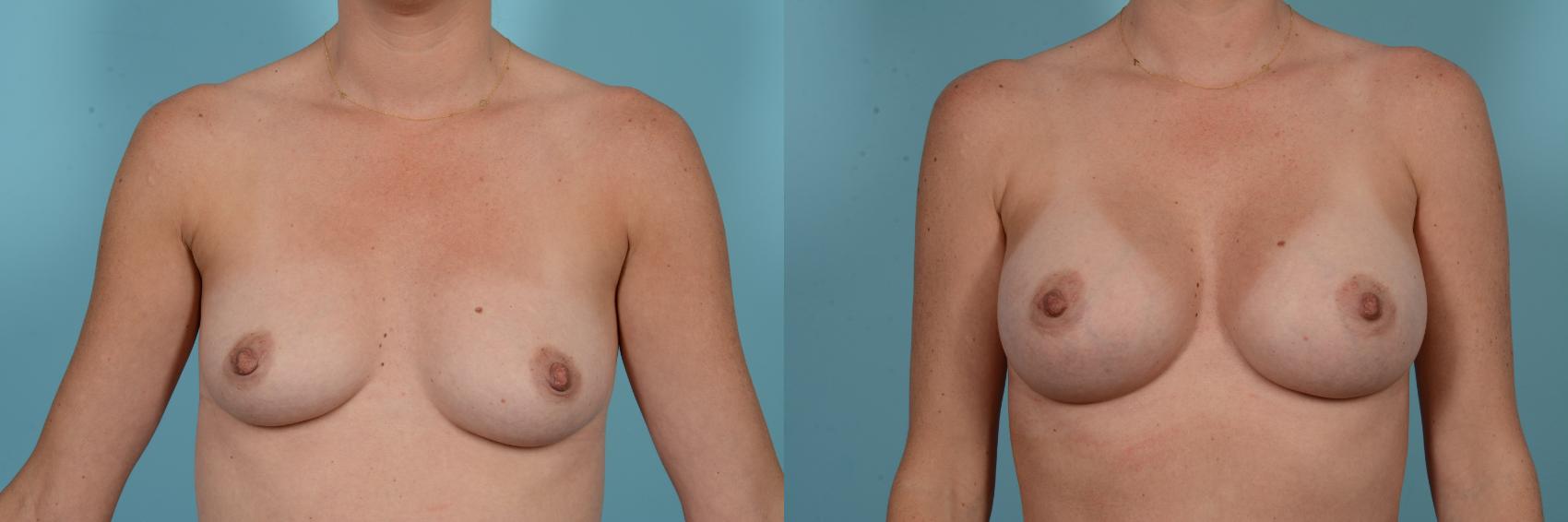 Before & After Breast Augmentation Case 799 Front View in Chicago, IL