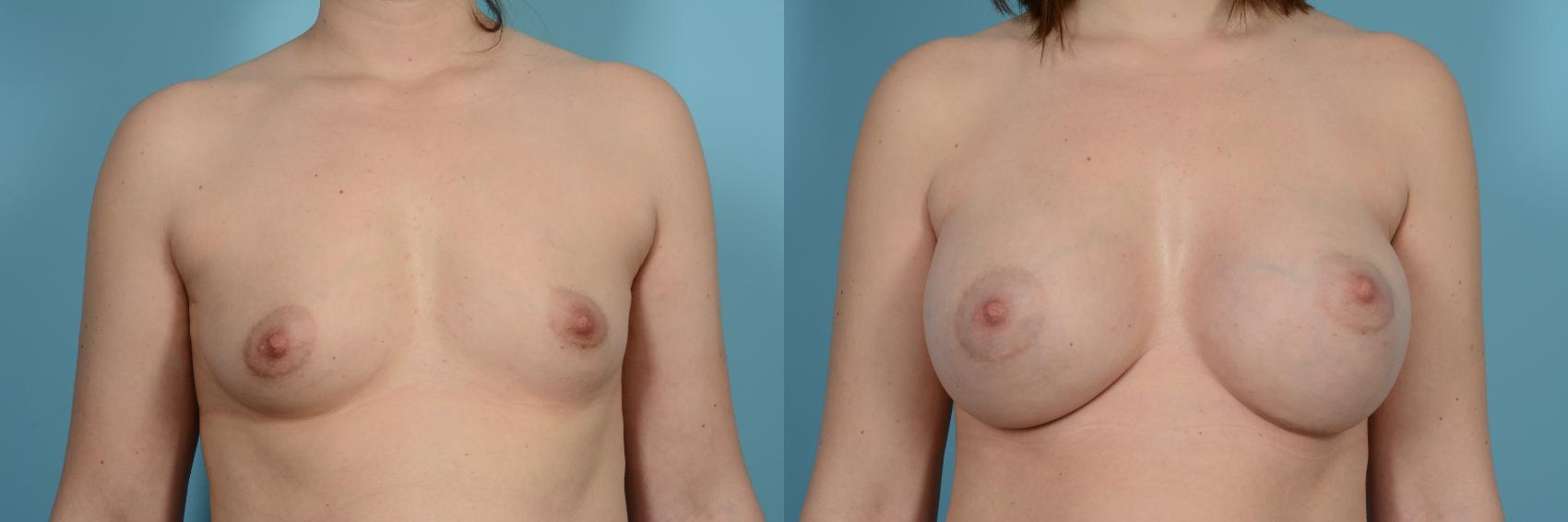 Before & After Breast Augmentation Case 820 Front View in Chicago, IL