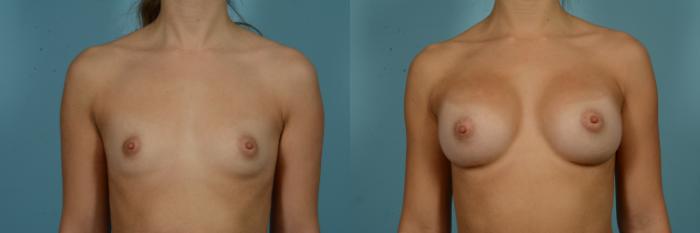 Before & After Breast Augmentation Case 837 Front View in Chicago, IL