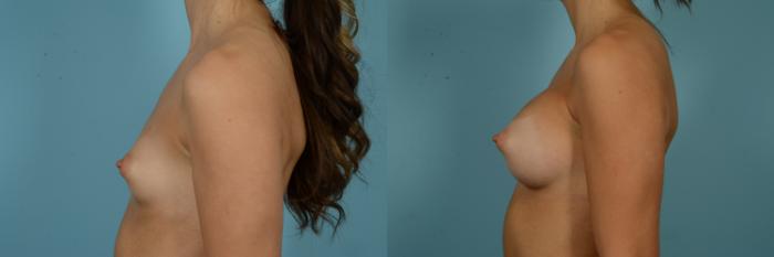 Before & After Breast Augmentation Case 837 Left Side View in Chicago, IL