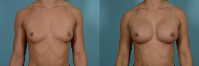 Before & After Breast Augmentation Case 858 Front View in Chicago, IL