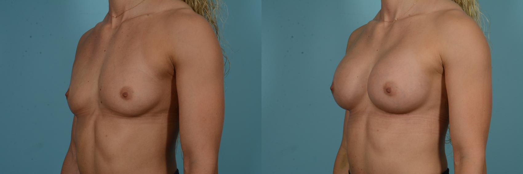 Before & After Breast Augmentation by Dr. Sinno Case 858 Left Oblique View in Chicago, IL