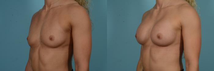 Before & After Breast Augmentation Case 858 Left Oblique View in Chicago, IL