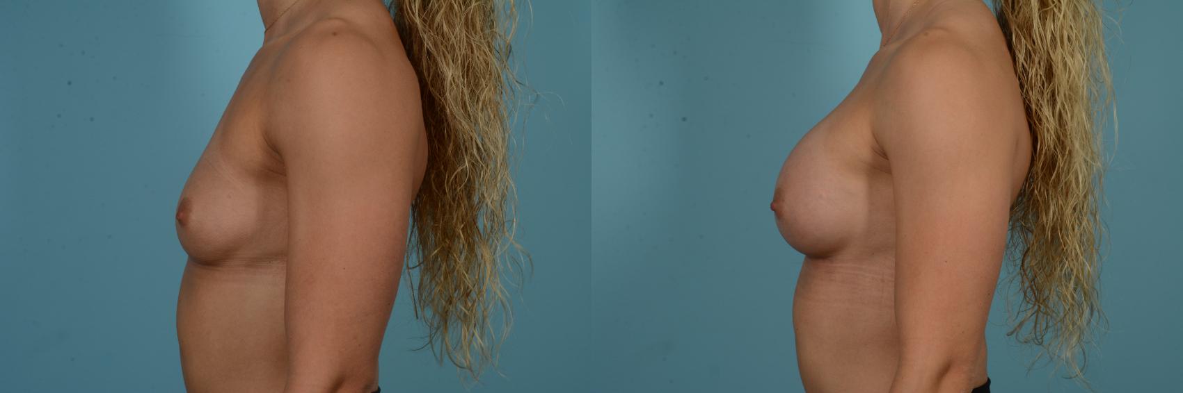 Before & After Breast Augmentation by Dr. Sinno Case 858 Left Side View in Chicago, IL