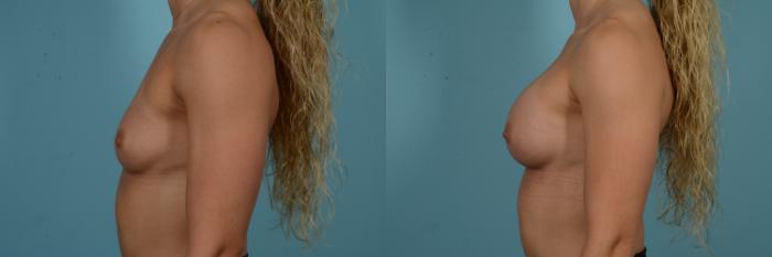 Before & After Breast Augmentation Case 858 Left Side View in Chicago, IL