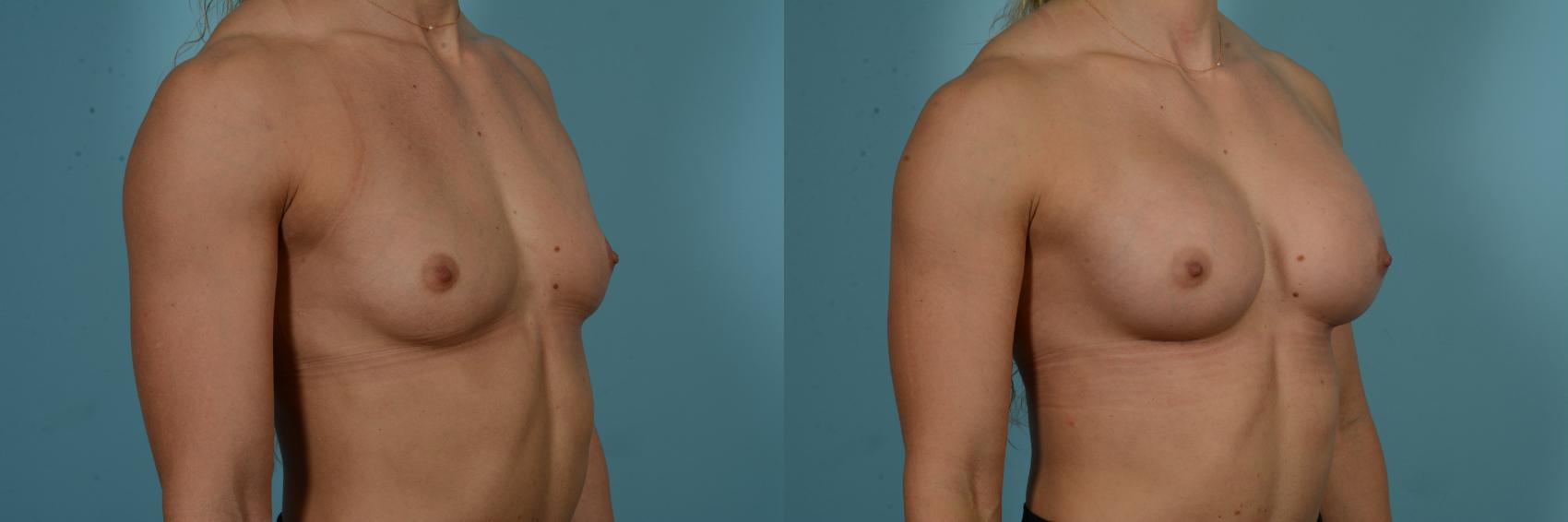 Before & After Breast Augmentation by Dr. Sinno Case 858 Right Oblique View in Chicago, IL