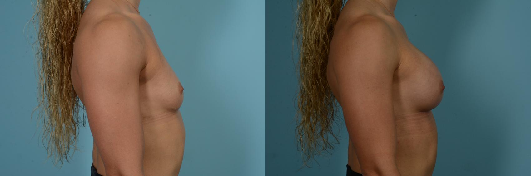 Before & After Breast Augmentation by Dr. Sinno Case 858 Right Side View in Chicago, IL