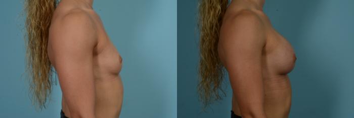Before & After Breast Augmentation Case 858 Right Side View in Chicago, IL