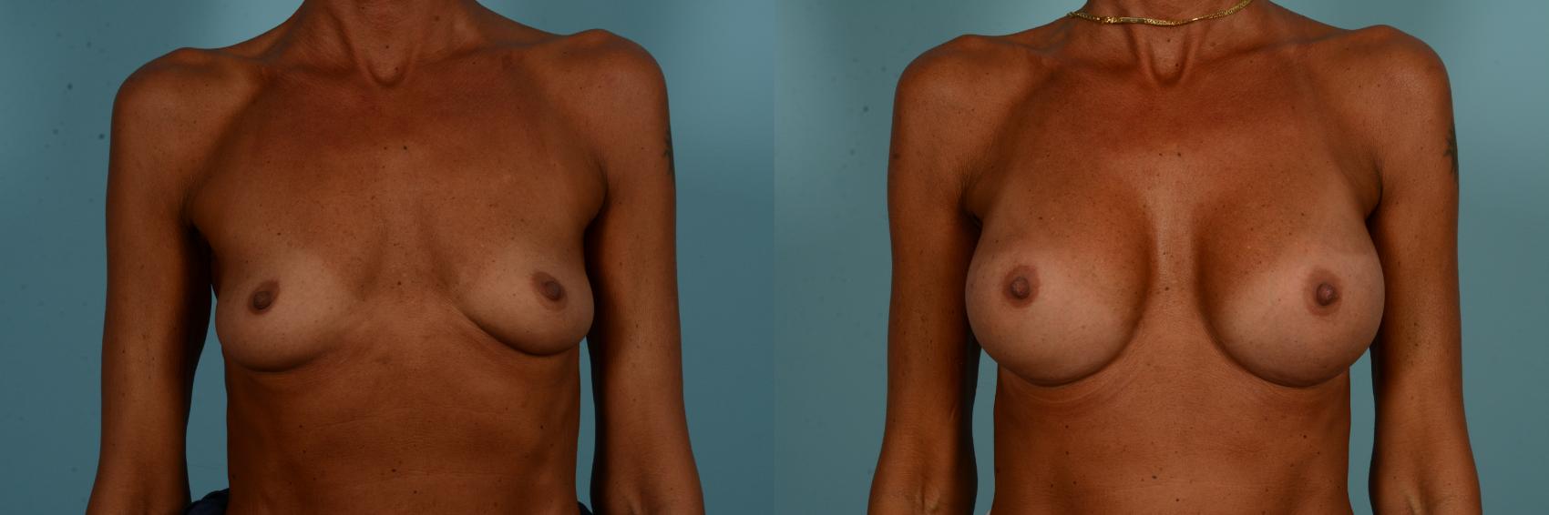 Before & After Breast Augmentation Case 894 Front View in Chicago, IL