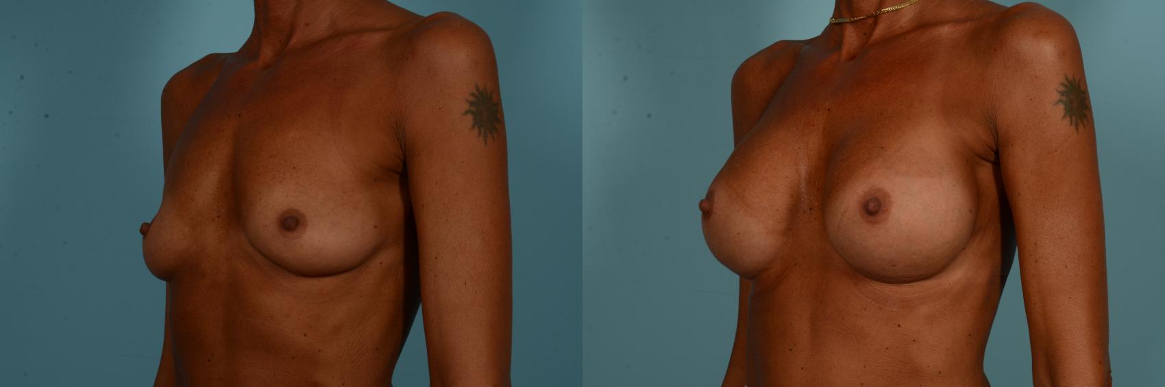 Before & After Breast Augmentation by Dr. Sinno Case 894 Left Oblique View in Chicago, IL