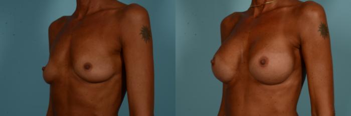 Before & After Breast Augmentation Case 894 Left Oblique View in Chicago, IL
