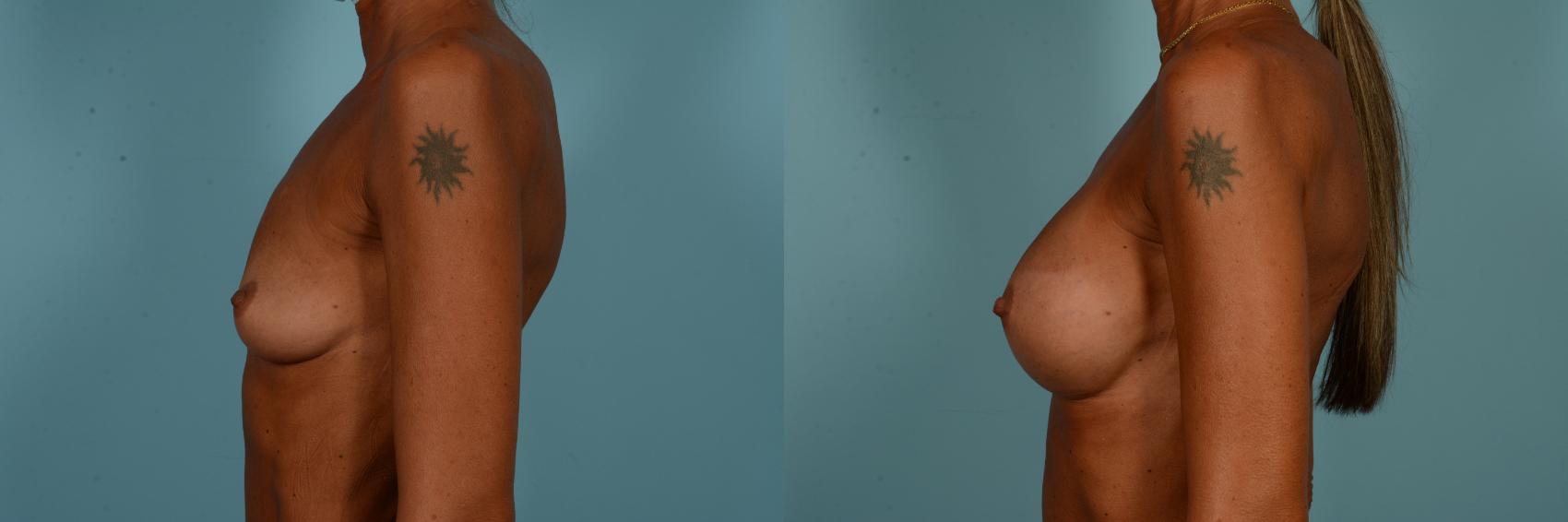Before & After Breast Augmentation by Dr. Sinno Case 894 Left Side View in Chicago, IL