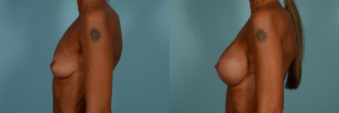 Before & After Breast Augmentation Case 894 Left Side View in Chicago, IL