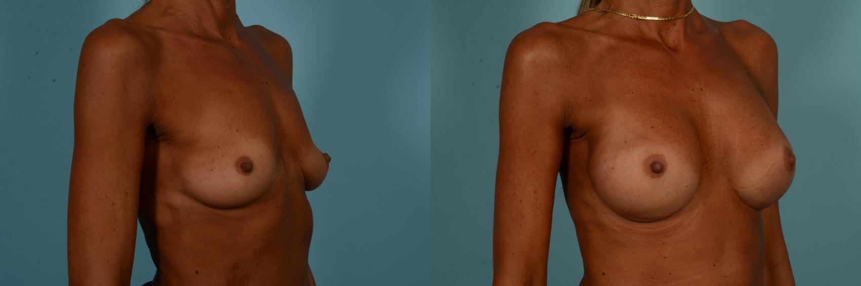 Before & After Breast Augmentation by Dr. Sinno Case 894 Right Oblique View in Chicago, IL