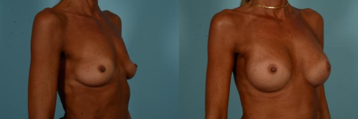 Before & After Breast Augmentation Case 894 Right Oblique View in Chicago, IL