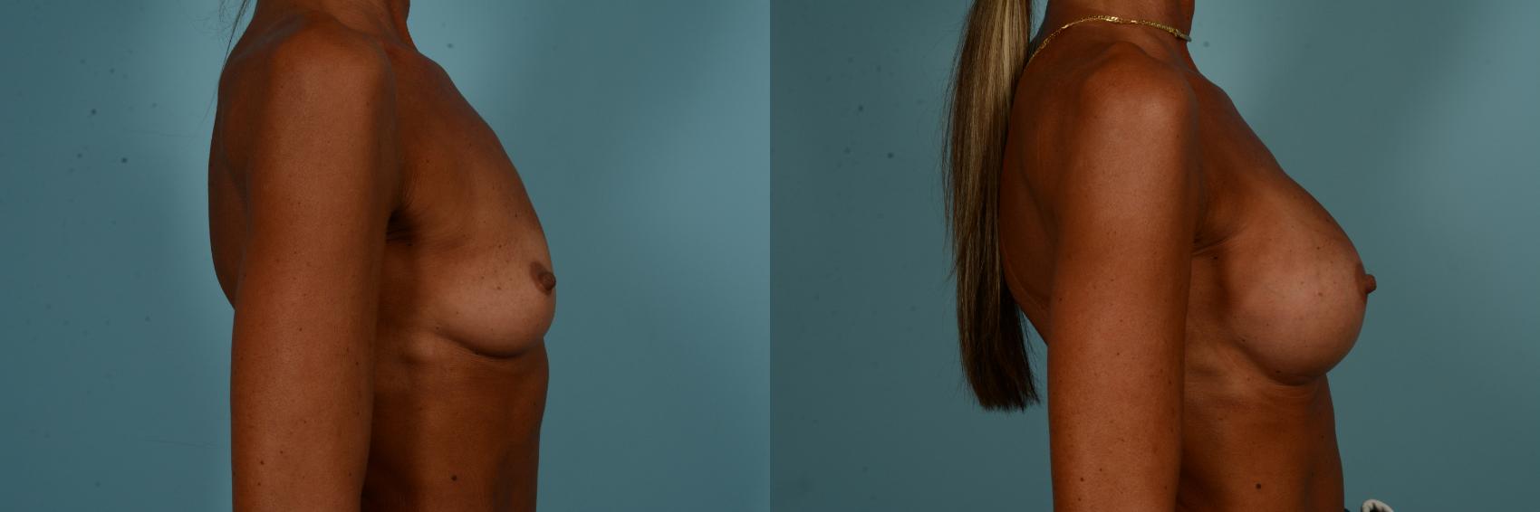 Before & After Breast Augmentation by Dr. Sinno Case 894 Right Side View in Chicago, IL