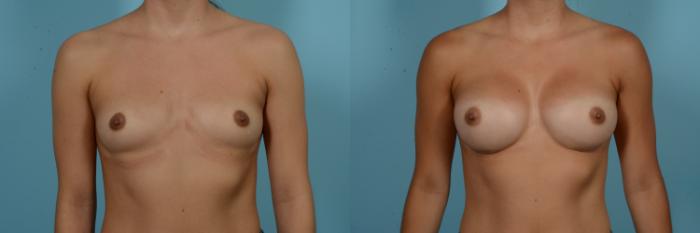 Before & After Breast Augmentation Case 901 Front View in Chicago, IL