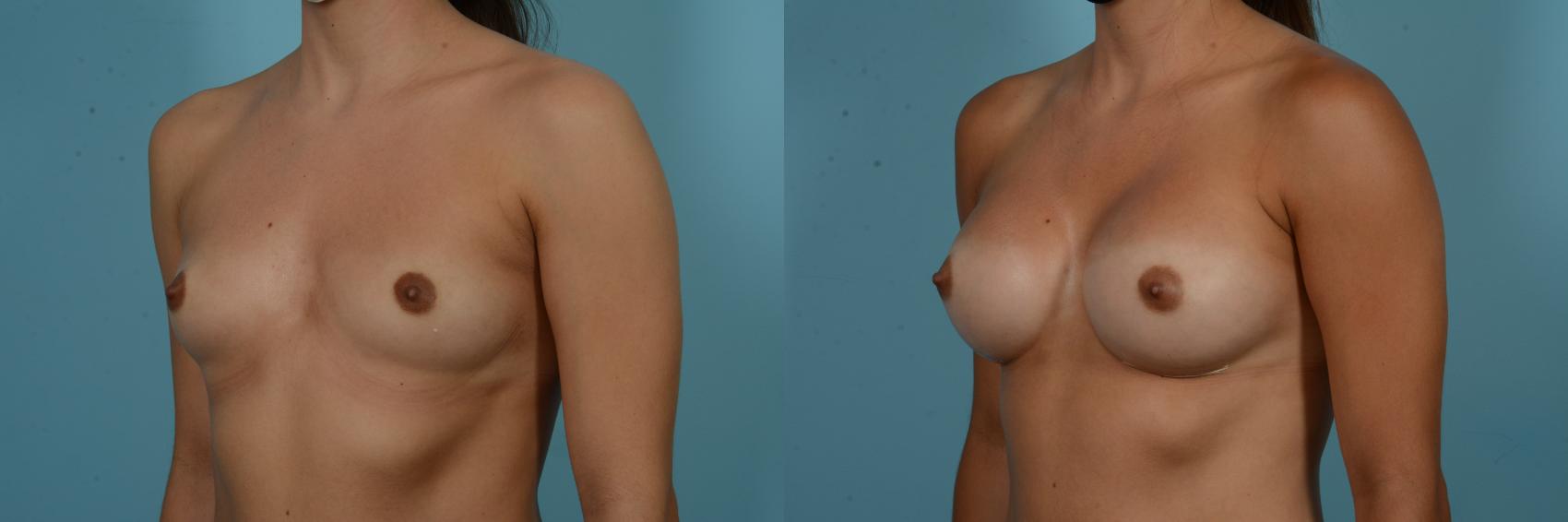 Before & After Breast Augmentation by Dr. Sinno Case 901 Left Oblique View in Chicago, IL