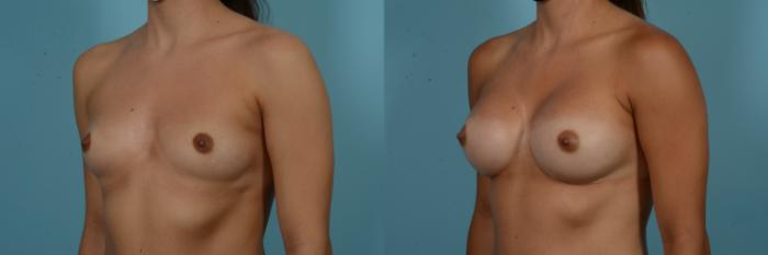 Before & After Breast Augmentation Case 901 Left Oblique View in Chicago, IL