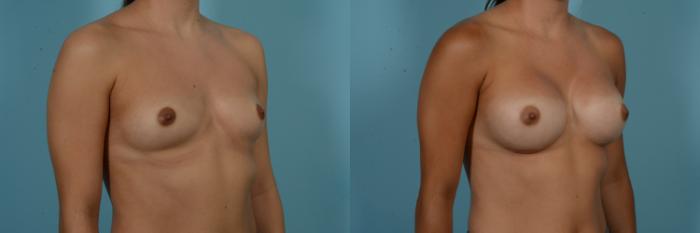 Before & After Breast Augmentation Case 901 Right Oblique View in Chicago, IL