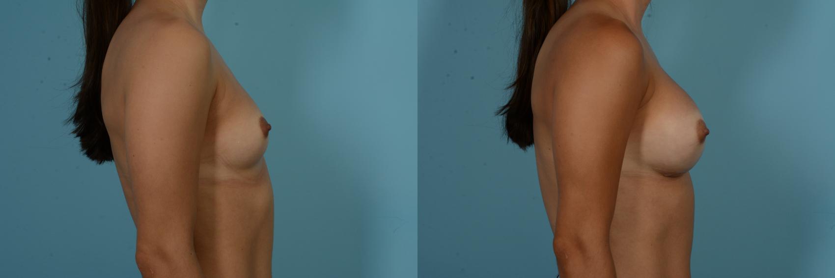 Before & After Breast Augmentation by Dr. Sinno Case 901 Right Side View in Chicago, IL