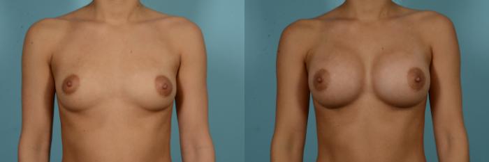 Before & After Breast Augmentation Case 909 Front View in Chicago, IL