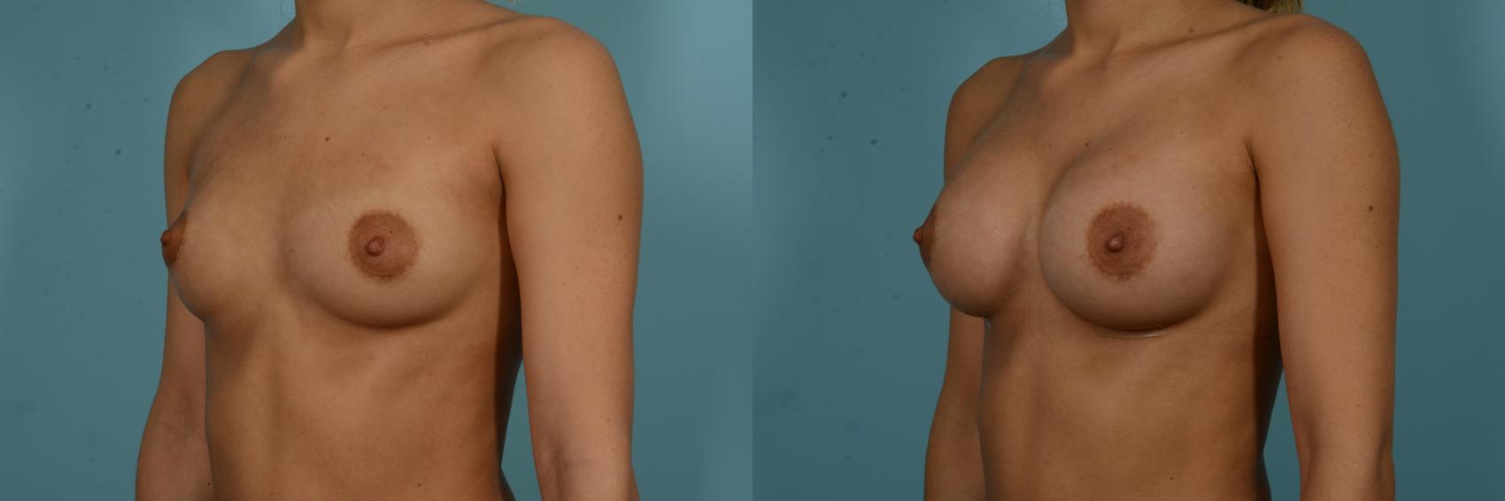 Before & After Breast Augmentation by Dr. Sinno Case 909 Left Oblique View in Chicago, IL