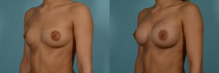 Before & After Breast Augmentation Case 909 Left Oblique View in Chicago, IL