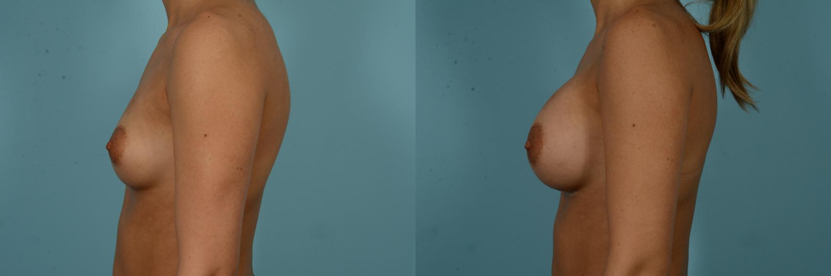 Before & After Breast Augmentation by Dr. Sinno Case 909 Left Side View in Chicago, IL
