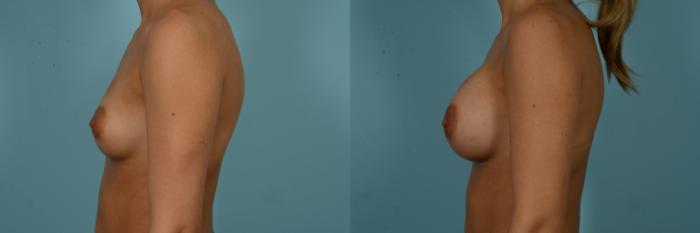 Before & After Breast Augmentation Case 909 Left Side View in Chicago, IL