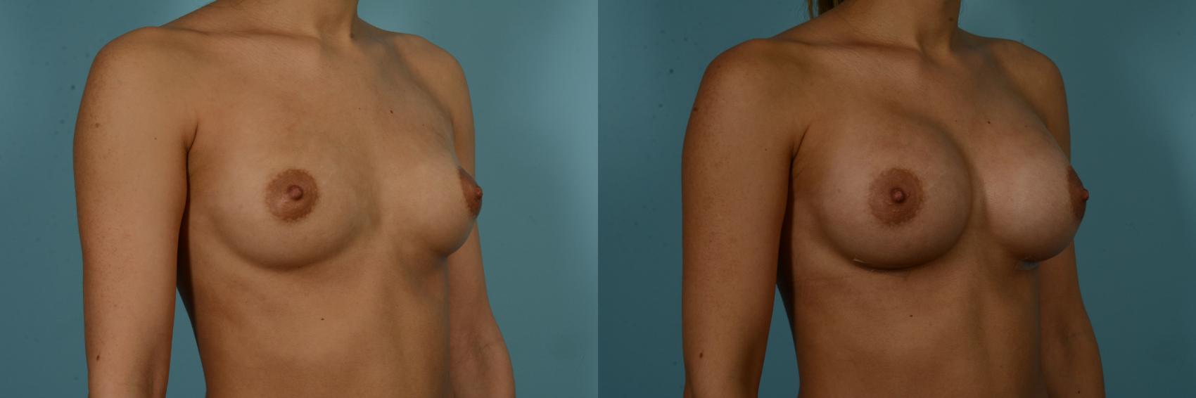 Before & After Breast Augmentation by Dr. Sinno Case 909 Right Oblique View in Chicago, IL
