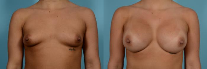 Before & After Breast Augmentation by Dr. Sinno Case 987 Front View in Chicago, IL