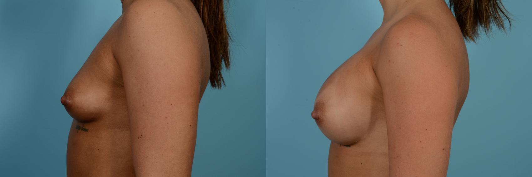 Before & After Breast Augmentation by Dr. Sinno Case 987 Left Side View in Chicago, IL
