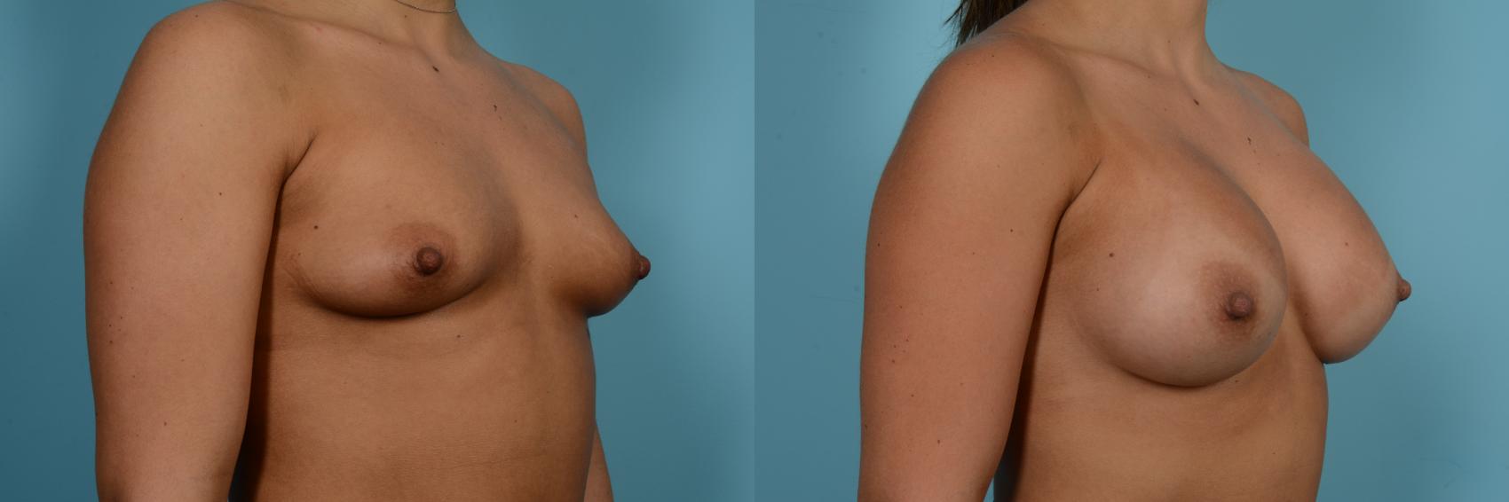 Before & After Breast Augmentation by Dr. Sinno Case 987 Right Oblique View in Chicago, IL