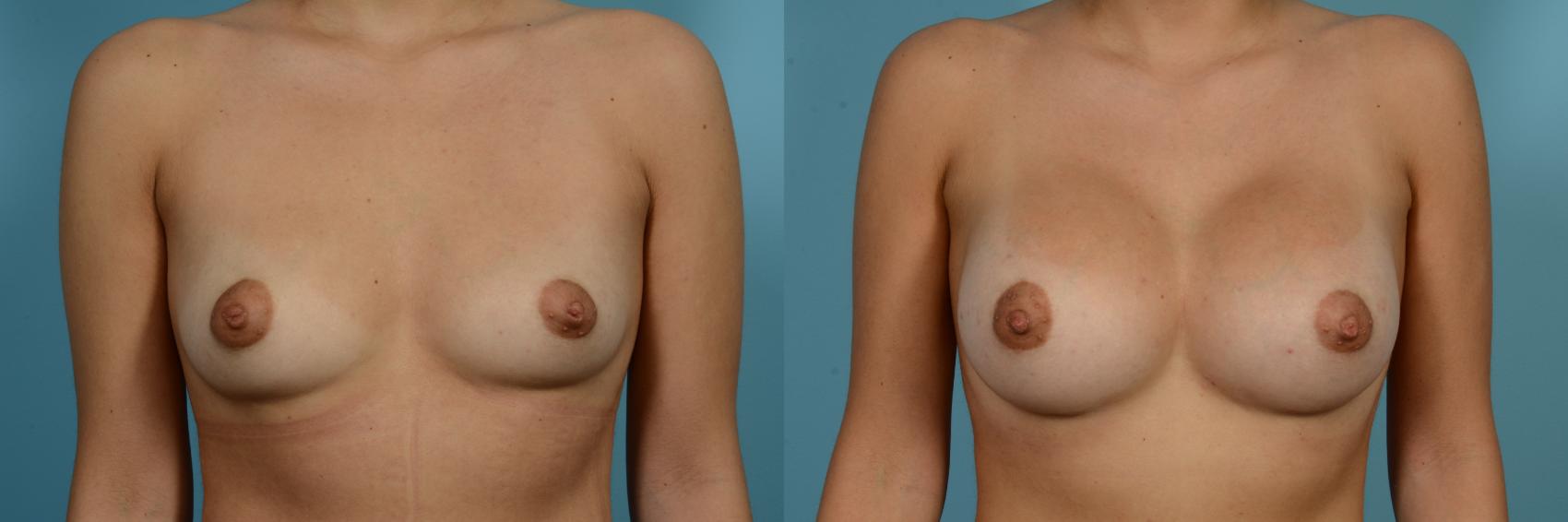 Before & After Breast Augmentation by Dr. Sinno Case 988 Front View in Chicago, IL