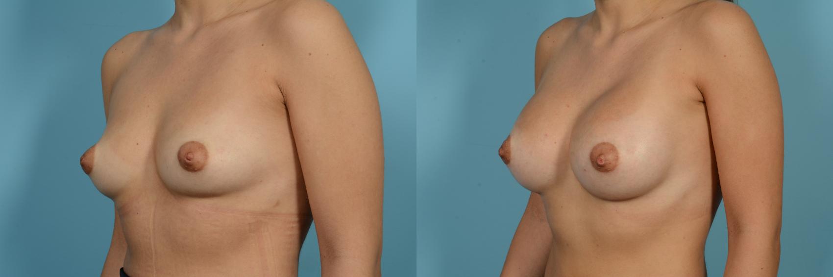 Before & After Breast Augmentation by Dr. Sinno Case 988 Left Oblique View in Chicago, IL