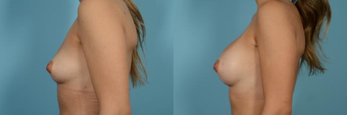 Before & After Breast Augmentation by Dr. Sinno Case 988 Left Side View in Chicago, IL