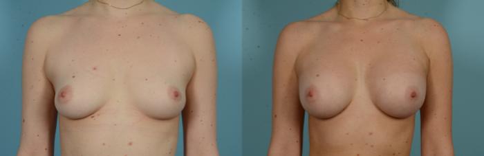 Before & After Breast Augmentation by Dr. Mustoe Case 1008 Front View in Chicago, IL