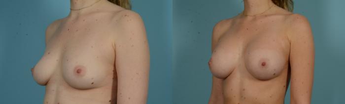 Before & After Breast Augmentation by Dr. Mustoe Case 1008 Left Oblique View in Chicago, IL