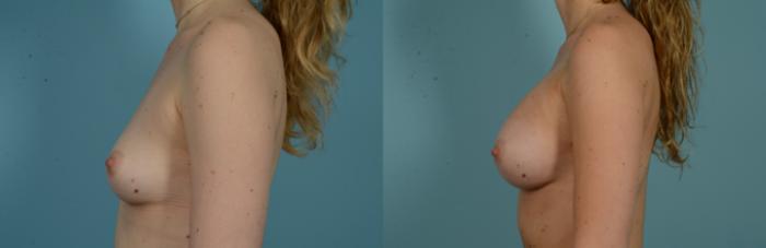 Before & After Breast Augmentation by Dr. Mustoe Case 1008 Left Side View in Chicago, IL