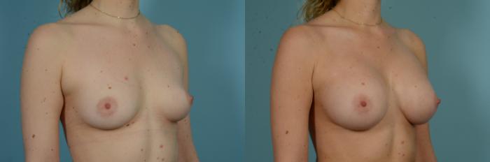 Before & After Breast Augmentation by Dr. Mustoe Case 1008 Right Oblique View in Chicago, IL