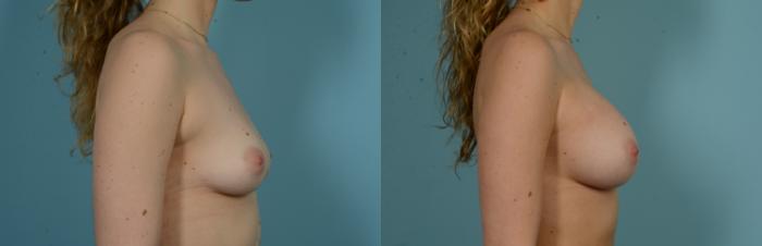 Before & After Breast Augmentation by Dr. Mustoe Case 1008 Right Side View in Chicago, IL