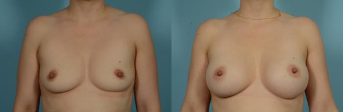 Before & After Breast Augmentation by Dr. Mustoe Case 1013 Front View in Chicago, IL