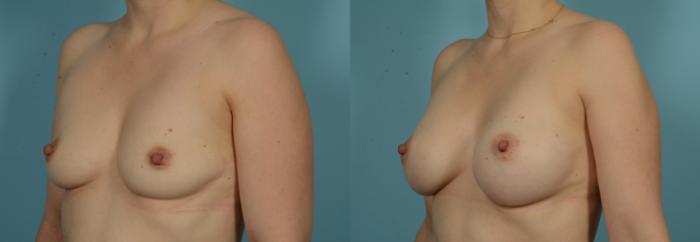 Before & After Breast Augmentation by Dr. Mustoe Case 1013 Left Oblique View in Chicago, IL