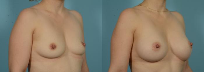 Before & After Breast Augmentation by Dr. Mustoe Case 1013 Right Oblique View in Chicago, IL